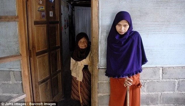 Редкая болезнь превратила тело девушки в бревно (фото)