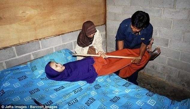 Редкая болезнь превратила тело девушки в бревно (фото)