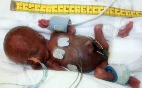 Шала туған сәби