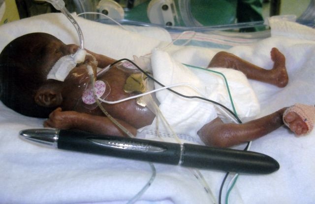 Шала туған бала