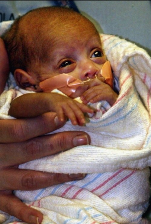 Шала туған сәби